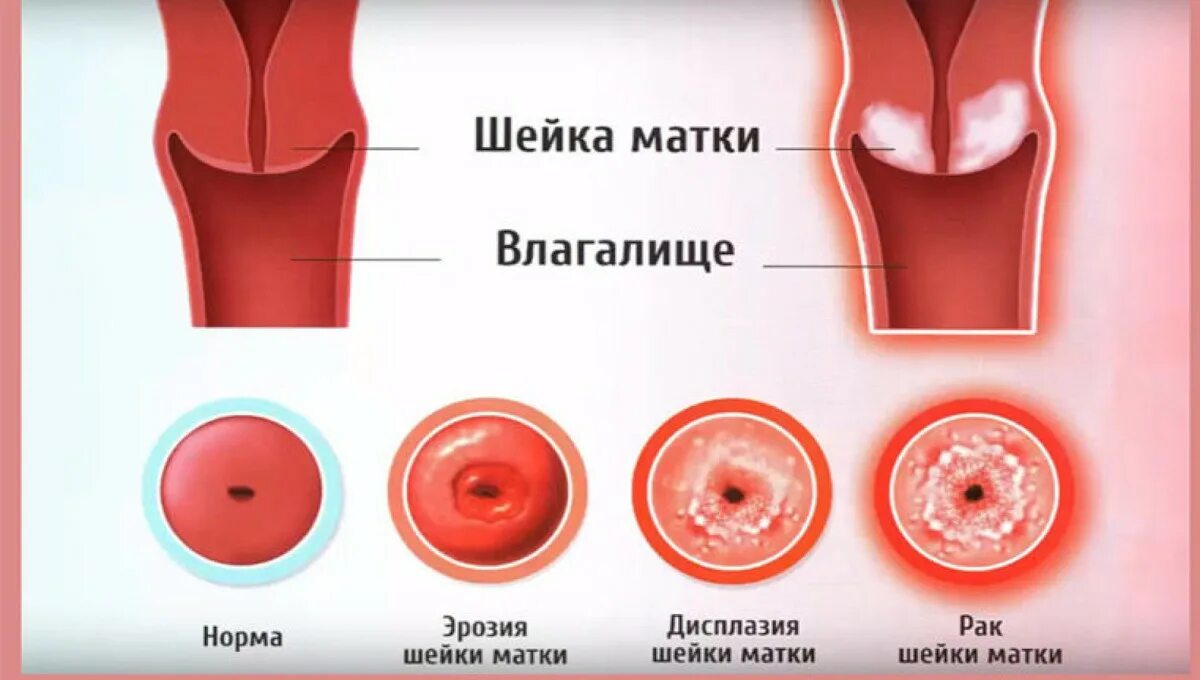 Влагалище Нерожавшей Женщины