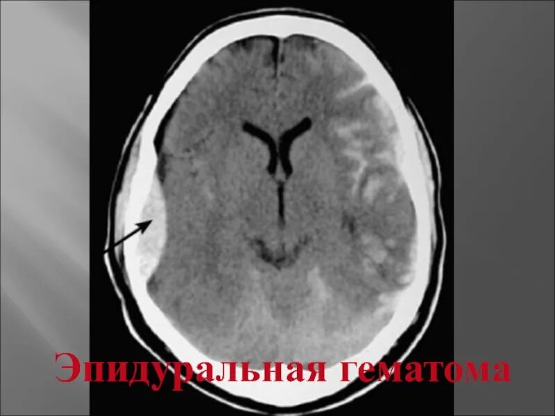 Кт эпидуральной гематомы. Эпидуральная гематома на кт. Внутричерепная гематома на кт. Субарахноидальное кровоизлияние головного кт.