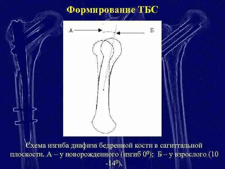 Диафиза бедренной кости. Перелом диафиза бедренной кости. Проксимальный диафиз бедренной кости. Проксимальный отдел бедренной кости рентген. Изгибы костей