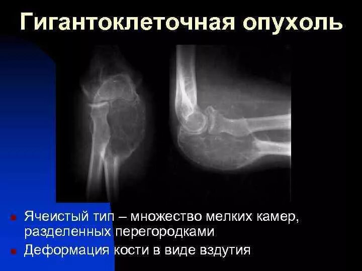 Гигантоклеточная опухоль мягких тканей гистология. Гигантоклеточная опухоль бедренной кости рентген. Гигантоклеточная опухоль бедренной кости рентген. Гигантоклеточная опухоль кости рентген. Гигантоклеточная опухоль.