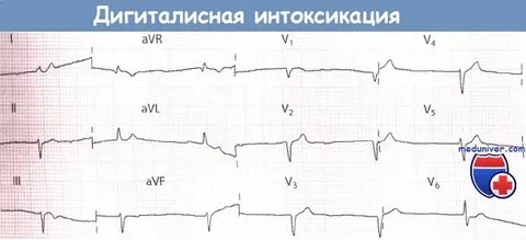 Интоксикация на экг