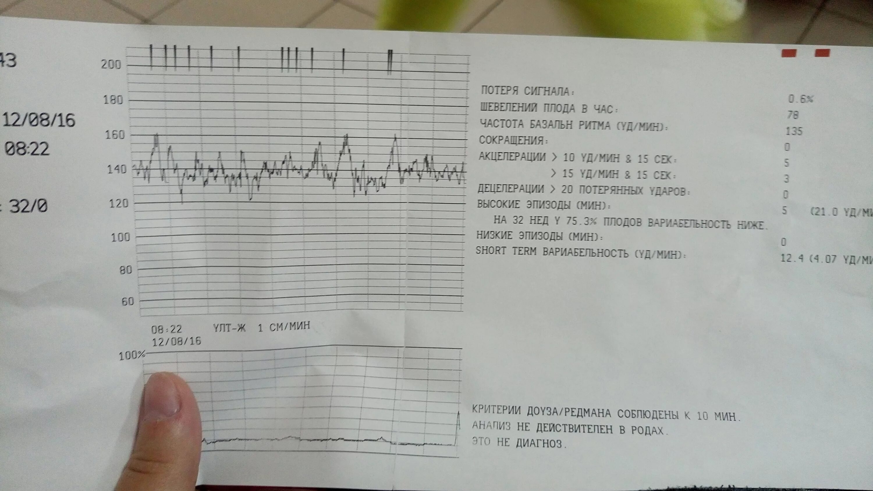 Шевеления на 37 неделе. Показатели КТГ плода норма таблица. Норма КТГ В 33 недели. Результат КТГ расшифровка 37 недель. КТГ при беременности расшифровка 37 недель норма.