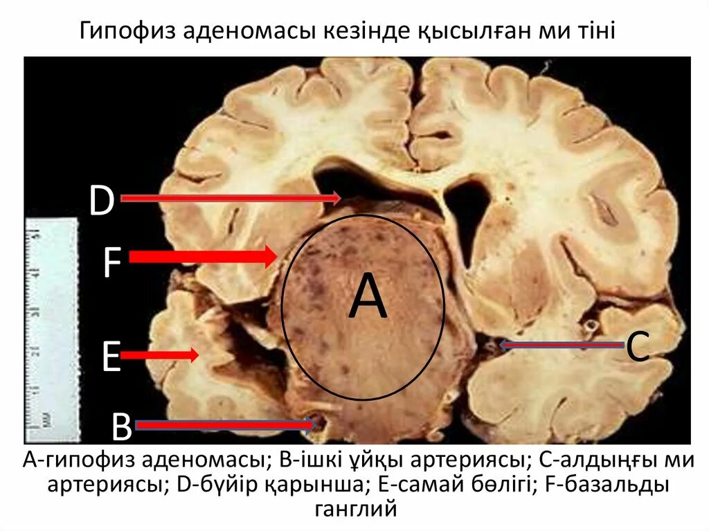 Эндосупраселлярная аденома гипофиза. Хромофобная аденома гипофиза клиника. Аденома гипофиза расположение. Микроаденома головного мозга.