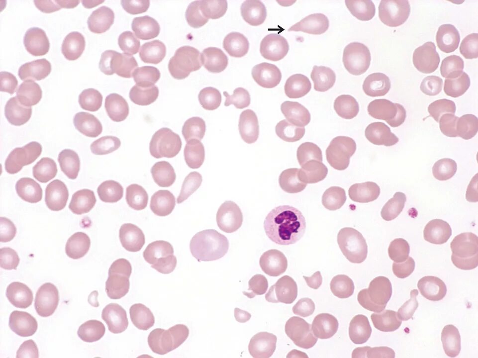 Пойкилоцитоз анемия. Пойкилоцитоз мазок. Пойкилоцитоз под микроскопом. Акантоцитоз. Гематологический мазок пойкилоцитоз в крови.