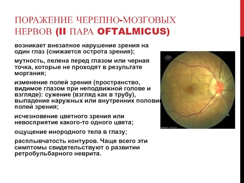 Поражение черепно-мозговых нервов. 2 Черепно мозговой нерв. Черепные нервы зрительный нерв. Поражение ерепномозговых нервов. Нарушения черепных нервов