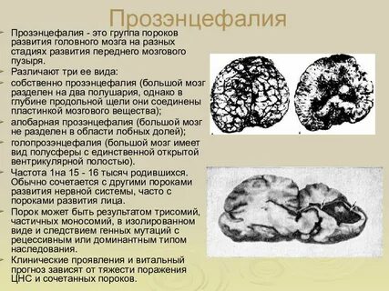 Врожденный порок мозга
