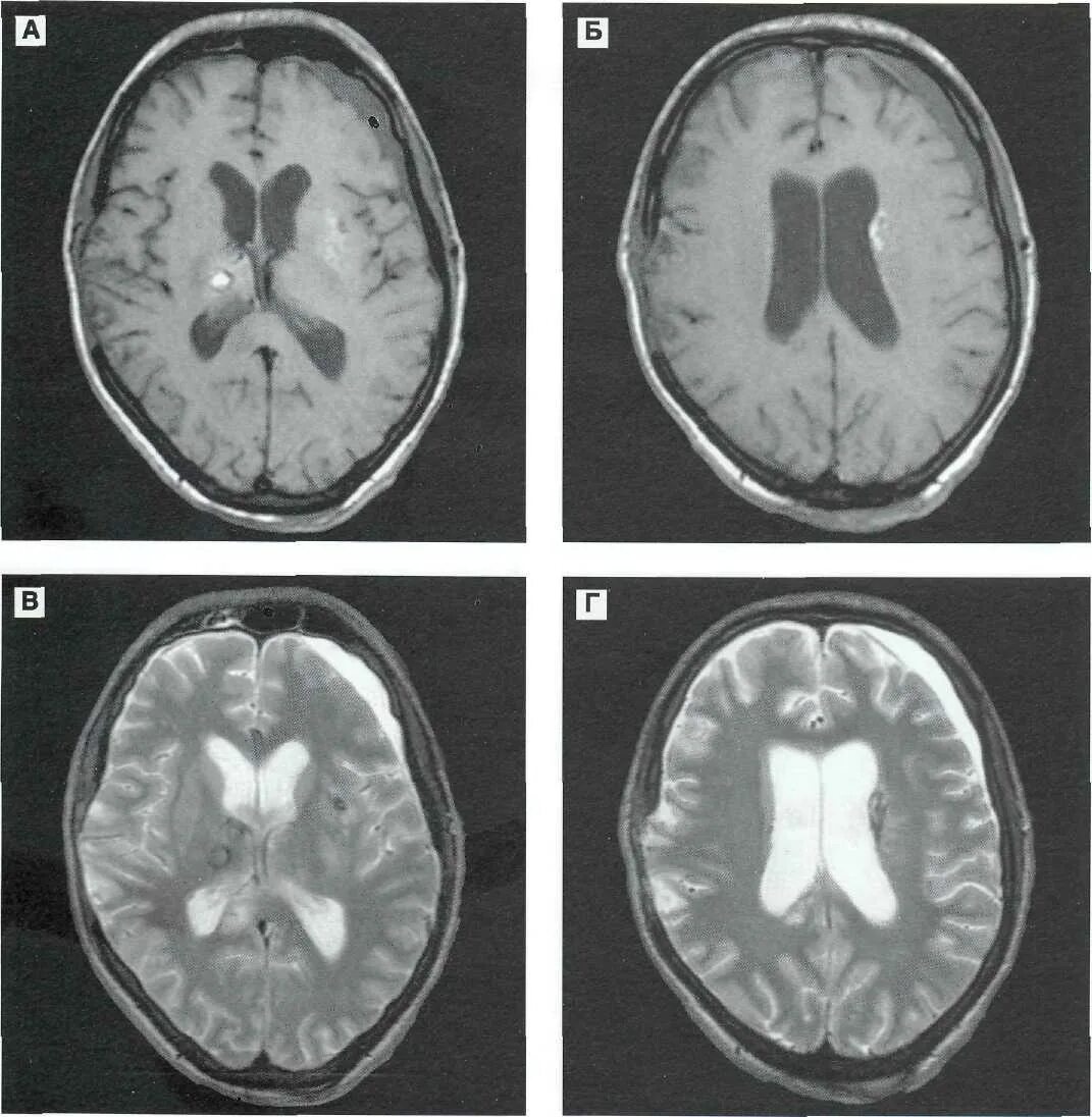 Диффузная атрофия головного мозга. Диффузное аксональное повреждение мозга. Аксональное повреждение головного мозга мрт. Диффузные аксональные повреждения головного мозга мрт. Диффузное аксональное повреждение мозга кт.