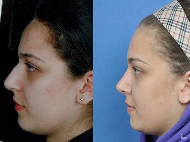 Пластическая операция со скольки лет. Ринопластика до и после. Ринопластика носа картошкой. Ринопластика огромного носа. Нос после пластики.