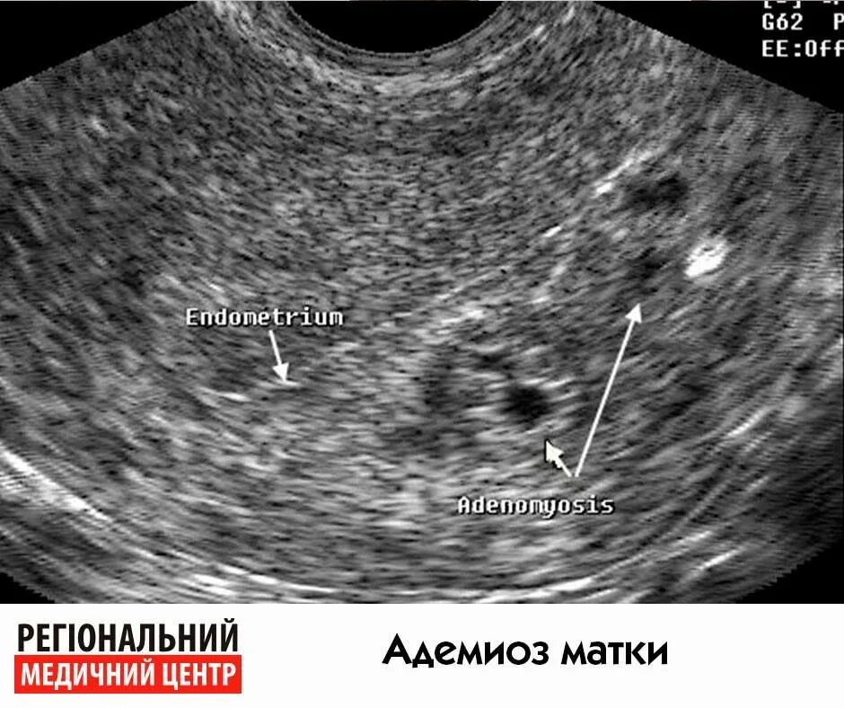 Эндометрий 3 мм. Эндометриоидные гетеротопии УЗИ. Диффузный эндометриоз матки УЗИ. Миометрия диффузно неоднородная. Узловая форма аденомиоза по УЗИ.