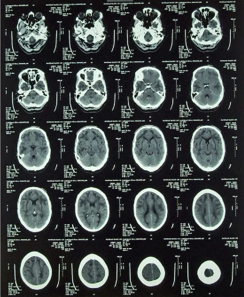 Компьютерная томография головного мозга норма. Мрт головного мозга расшифровка снимков. Мрт головного мозга норма. Кт снимок головного мозга здорового человека.