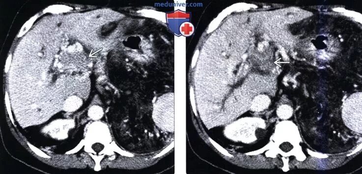 Гиповаскулярные метастазы печени кт. Гиповаскулярные образования печени на кт. Лимфатические узлы ворот печени на кт. Лимфоузлы в воротах печени кт. Лимфаденопатия ворот печени