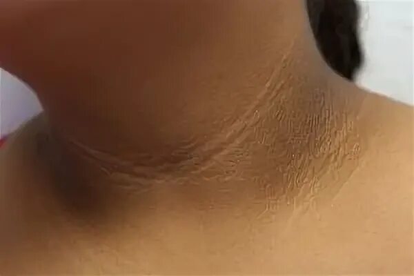 Por qué salen las manchas oscuras en el cuello y en otras partes del cuerpo? - T