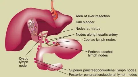 Cholelithiasis латынь