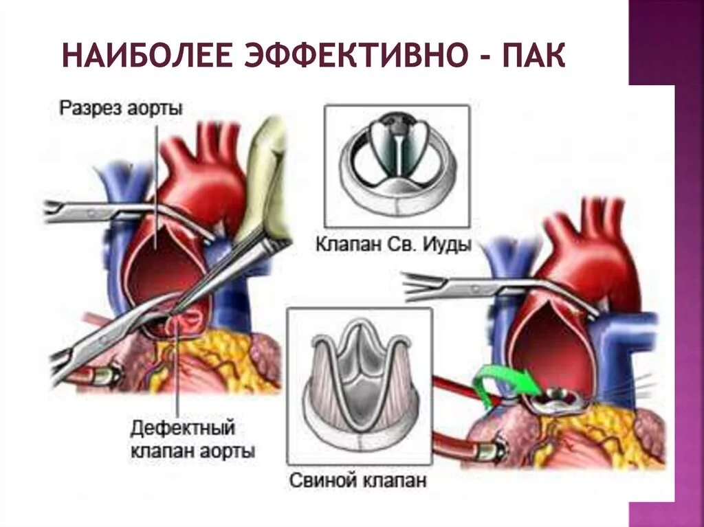 Осложнения стеноза