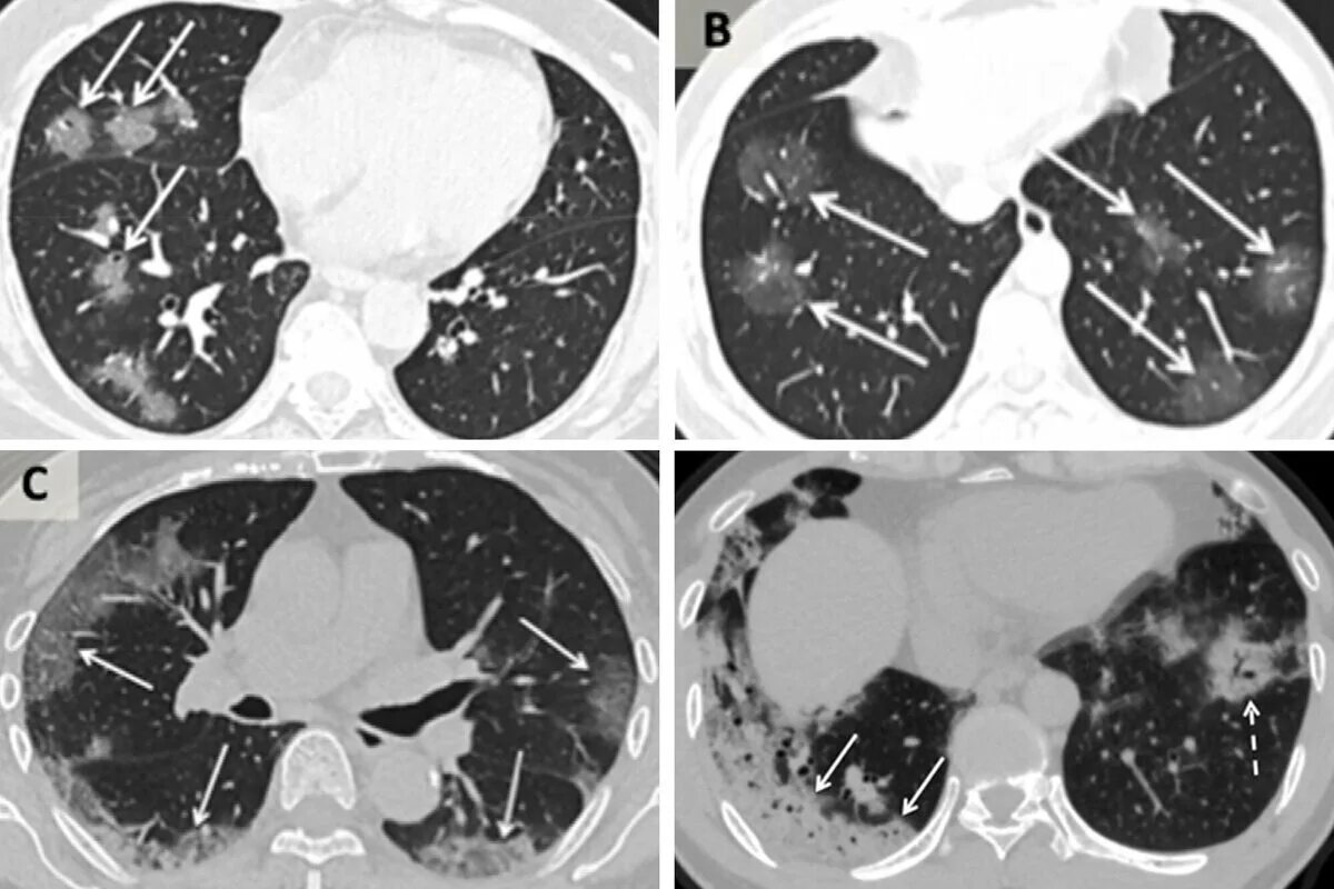10 поражение легких. Коронавирусная пневмония на кт. Кт легких пневмония коронавирус. Очаговая пневмония кт. Вирусная пневмония ковид кт.