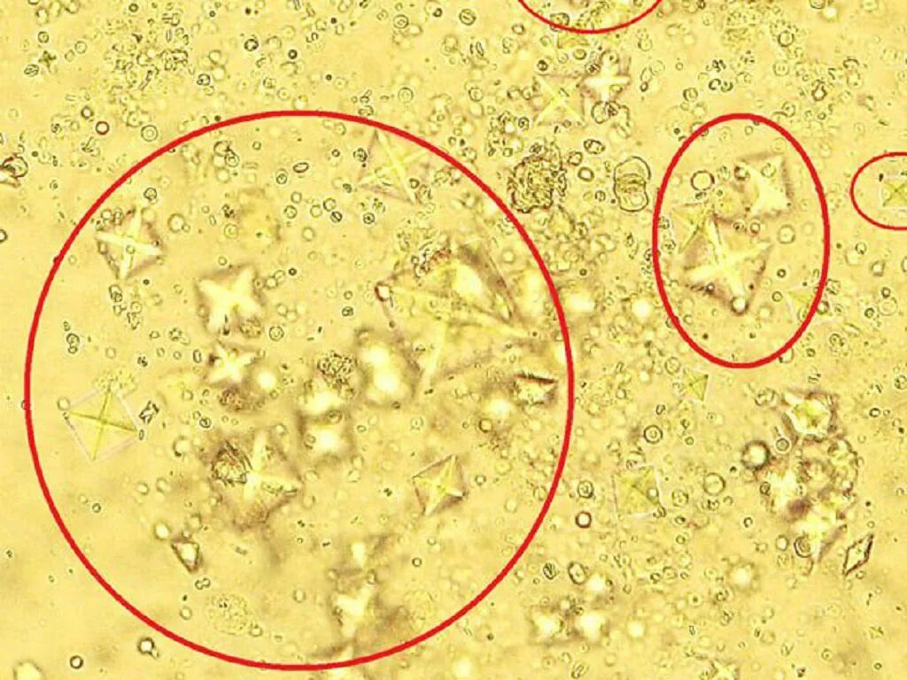 Оксалаты кальция в моче под микроскопом. Оксалаты кальция в осадке мочи. Оксалаты кальция в моче микроскопия. Микроскопия мочи Кристаллы оксалаты.