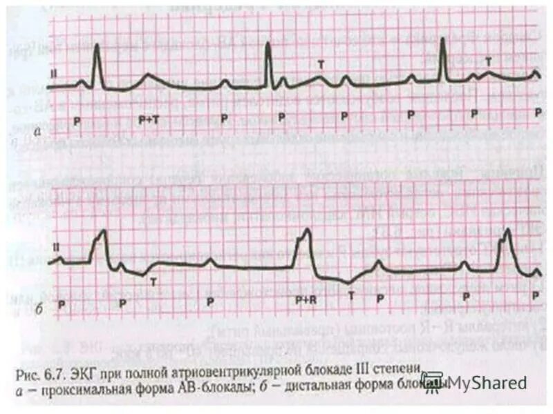Блокада на первом. Av блокада 1 ст. АВ блокада 2 степени Мобитц 1 ритм. ЭКГ при атриовентрикулярной блокаде 2 степени. АВ блокада 3 степени заключение.
