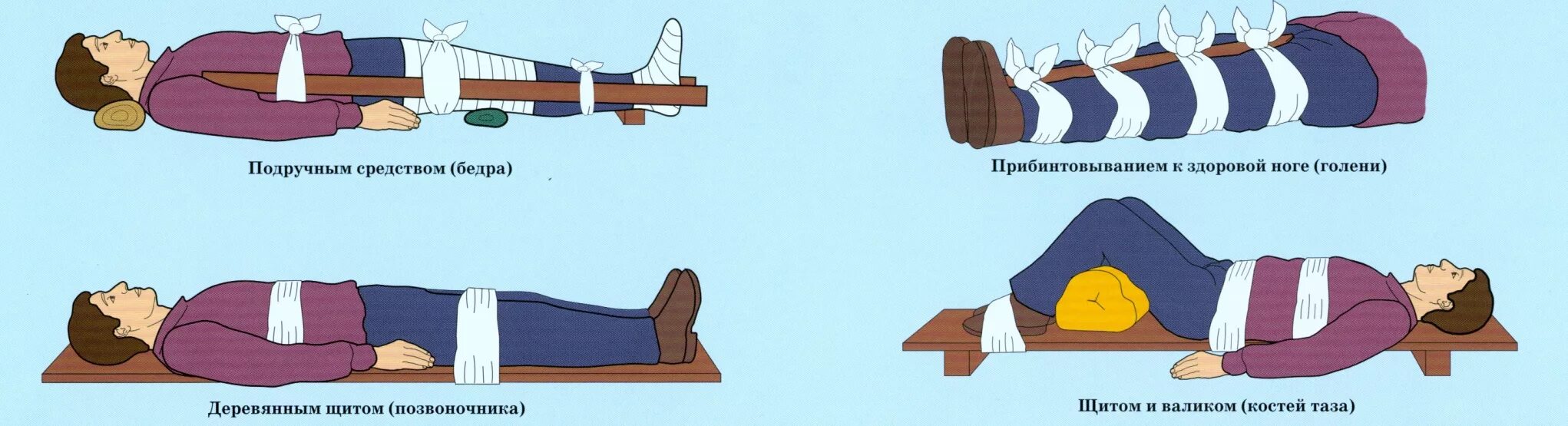 Транспортная иммобилизация при травме позвоночника. Перелом позвоночника иммобилизация первая помощь. Перелом позвоночника компрессионный ПМП. Иммобилизация при компрессионном переломе позвоночника.