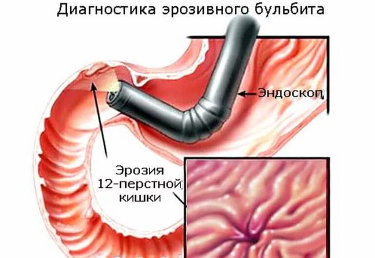 12 перстная кишка лечится. Язва желудка и 12 перстной кишки. Язвенная болезнь желудка и 12 перстной кишки. 12 перстная кишка лечится. Язвенная болезнь желудка и 12-ти перстной кишки.