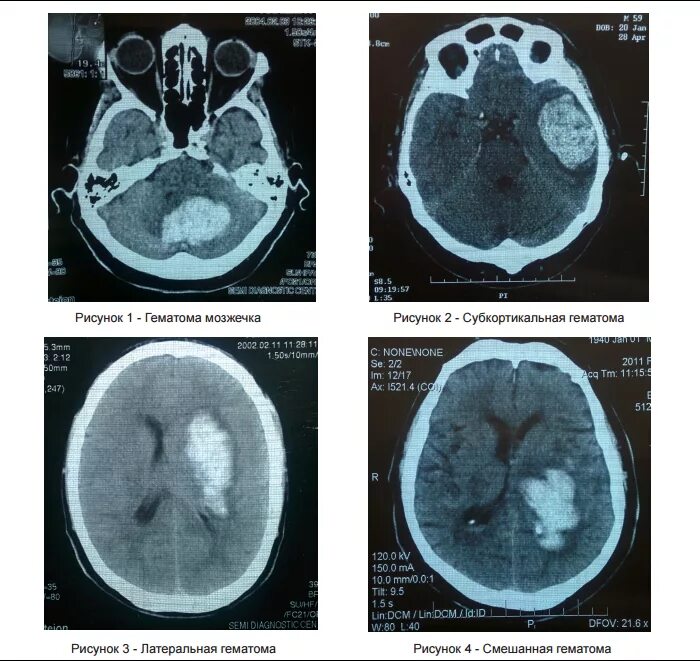 Внутримозговая гематома классификация кт. Геморрагический инсульт кт. Геморрагический инсульт внутримозговая гематома. Субкортикальная гематома внутримозговая. Гематома мозга операция