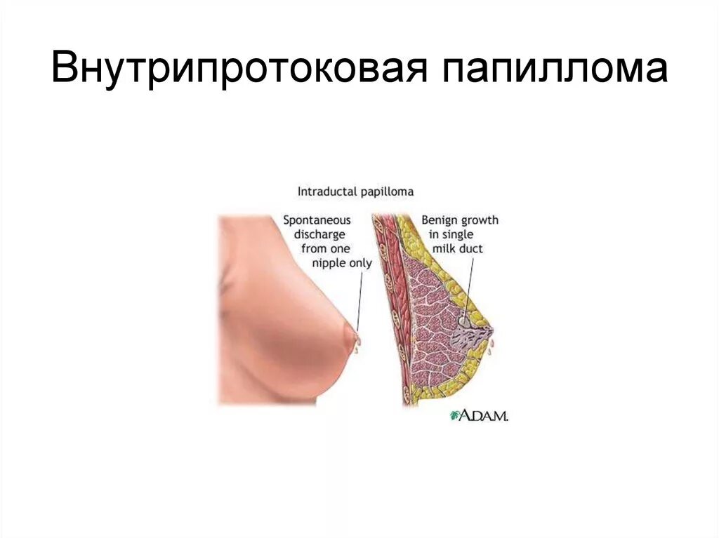 Папилломы протоков молочных желез