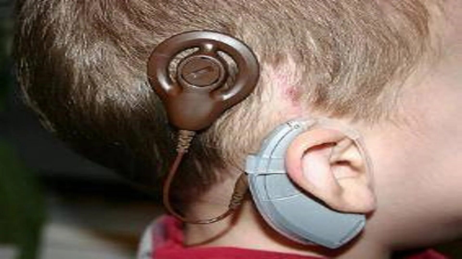 Слуховой аппарат для детей. Слуховой аппарат в голове. Слуховой аппарат 2 степень тугоухости. Слуховой аппарат на затылке. Операция на ухо на слух