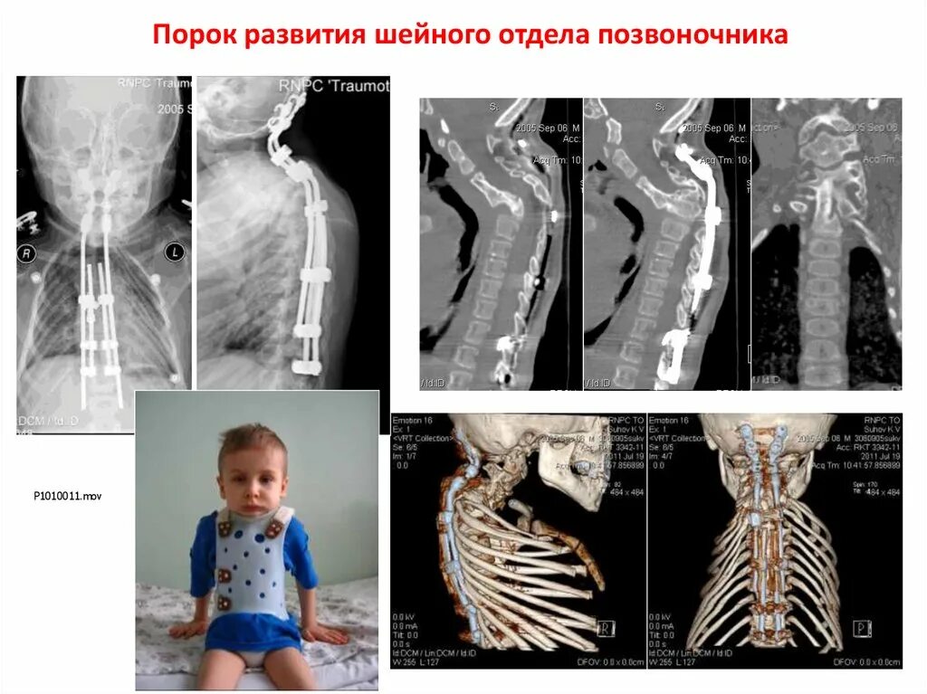 Аномалии развития шейного отдела. Врожденная аномалия развития шейного отдела позвоночника.