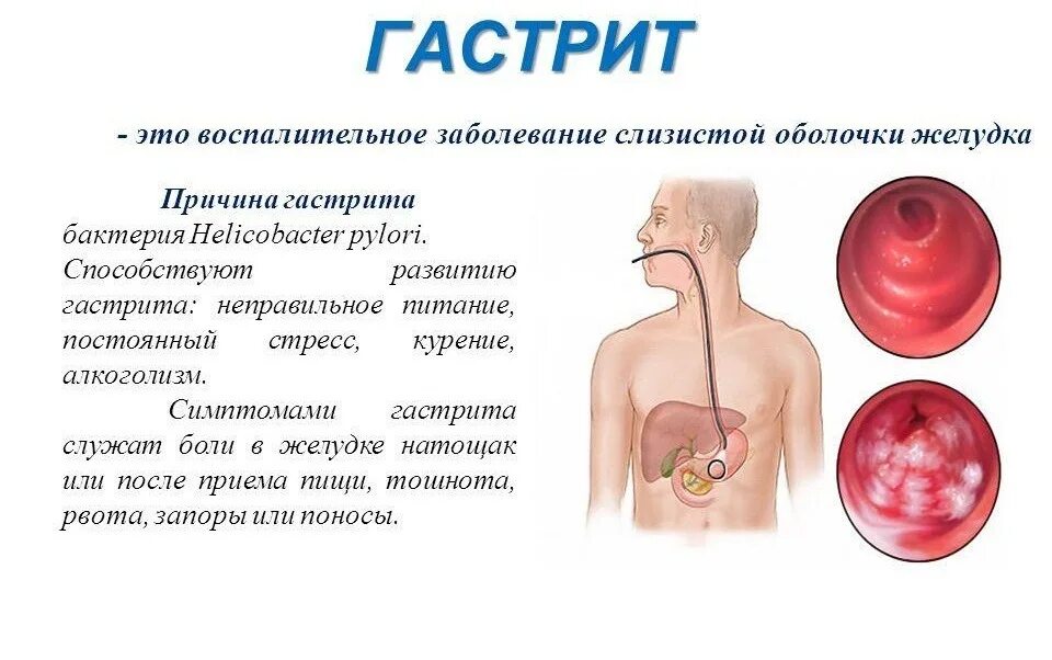 Заболевания желудка человека. Гастрит причины симптомы.