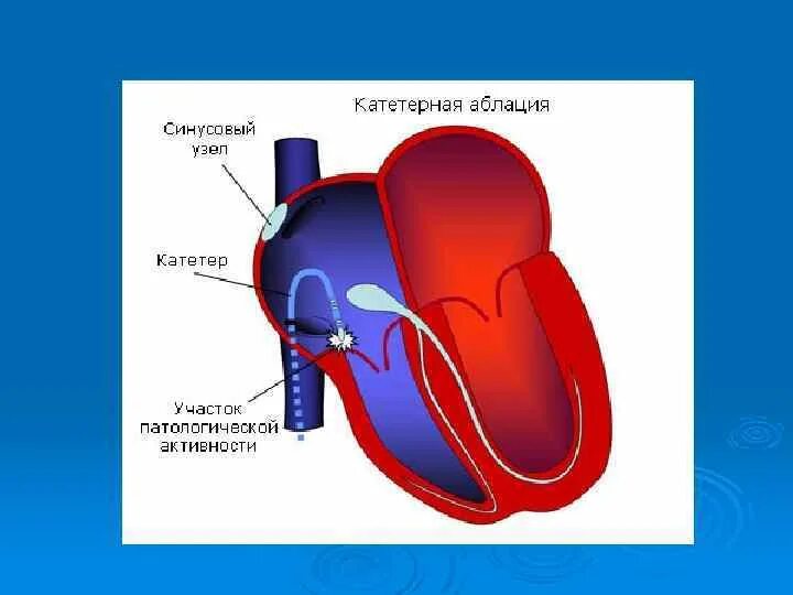 Рча предсердий. Радиочастотная катетерная абляция. Радиочастотная аблация аритмий сердца. Предсердий катетерная абляция. Катетерная абляция фибрилляции предсердий.