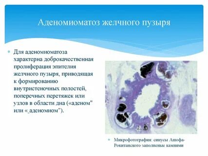 Аденомиоматоз желчного пузыря