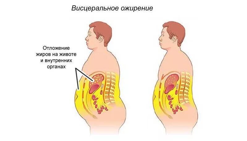 Ожирение степень 1 степени у мужчин. Абдоминальное и висцеральное ожирение. Висцеральное ожирение 1 степени. Ожирение 1 степени висцеральный Тип.