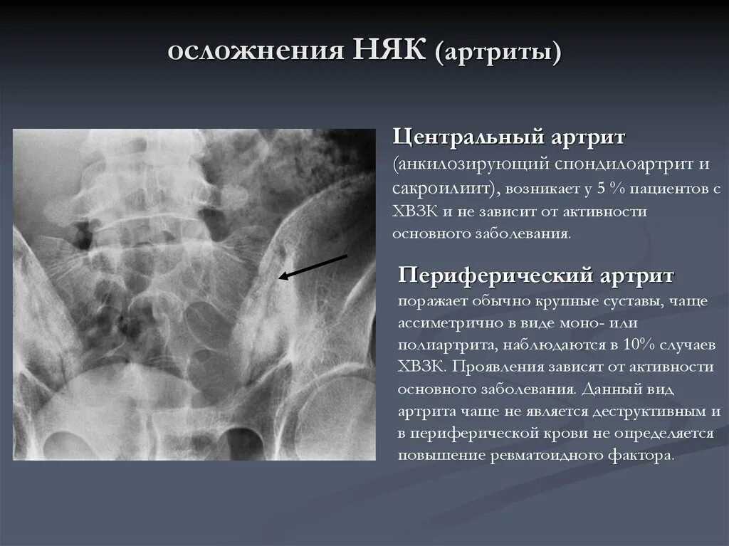 Неспецифические осложнения. Периферический артрит. Болезнь крона на рентгенограмме. Артрит при язвенном колите.