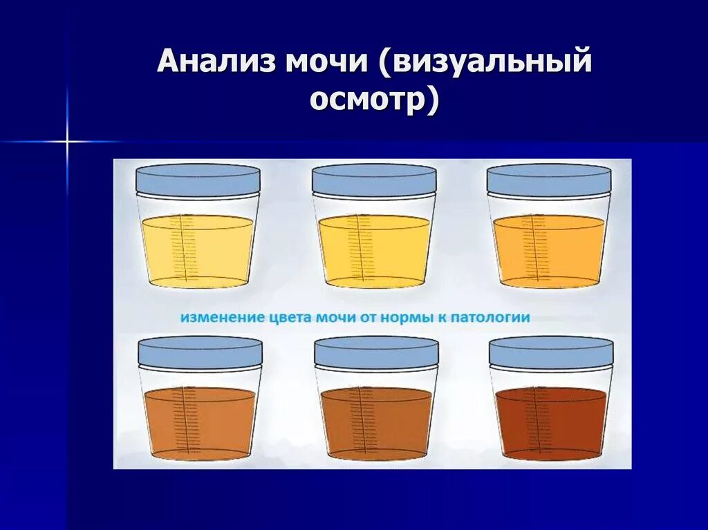 Как отличить мочу. Изменение цвета мочи. Визуальный анализ мочи. Анализ мочи цвет. Цвет мочи пропедевтика.