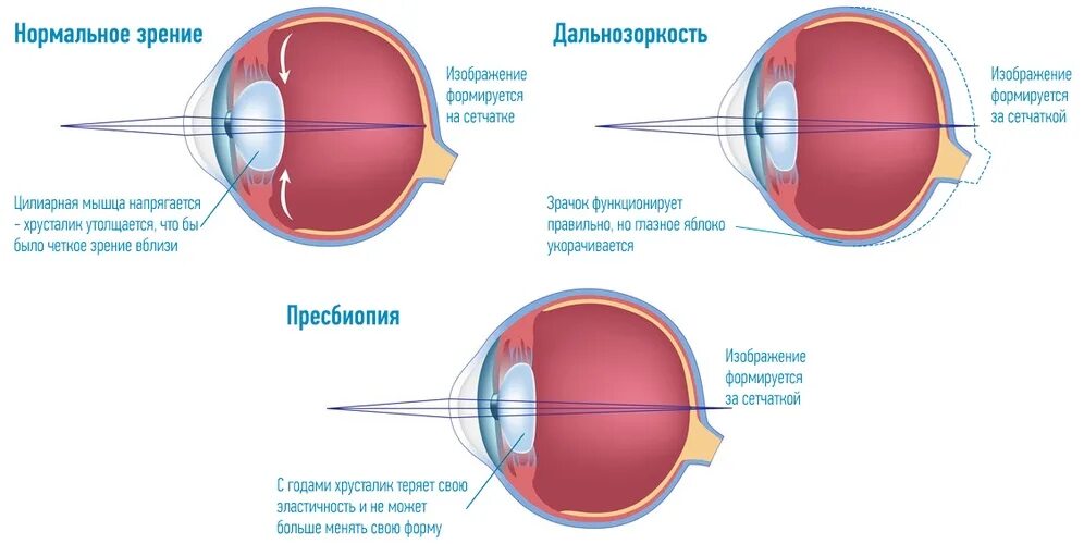 Таблица заболевания глаз близорукость и дальнозоркость. Старческая дальнозоркость (что это такое? Методы коррекции). Возрастные изменения сетчатки. Заболевание 1)  близорукость 2)  дальнозоркость. Плохо вижу в линзах