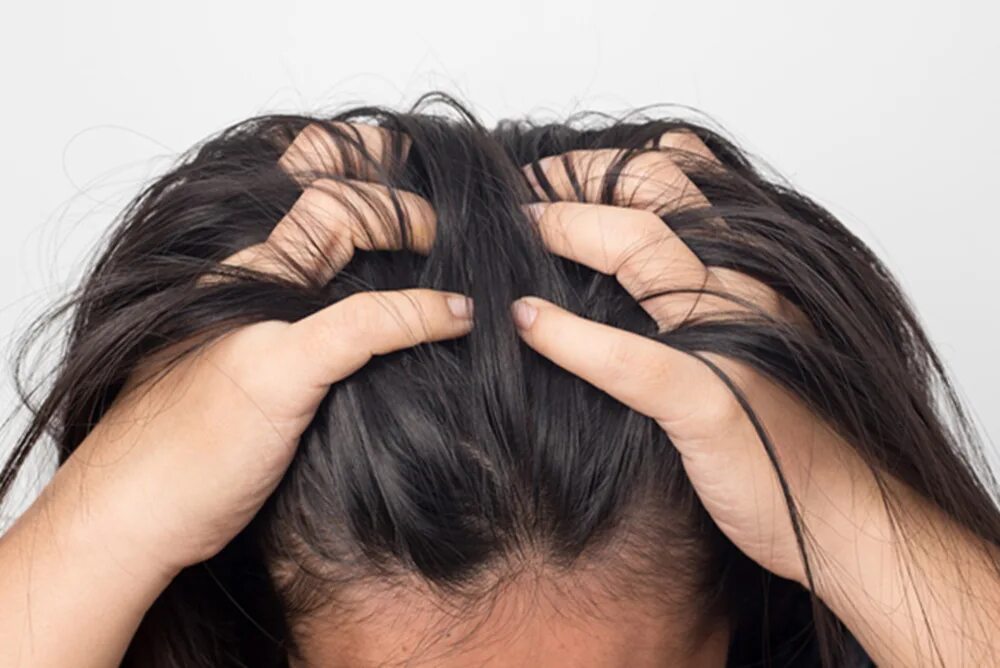 Лечим раздражение головы. Поредение волос. Отрубевидный лишай; себорейный дерматит. Такропик себорейный дерматит. Лечим раздражение головы.