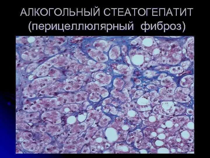 Алкогольный фиброз. Цирроз печени гистология. Мелкоузловой цирроз печени микропрепарат. Алкогольный фиброз печени микропрепарат. Алкогольный фиброз.