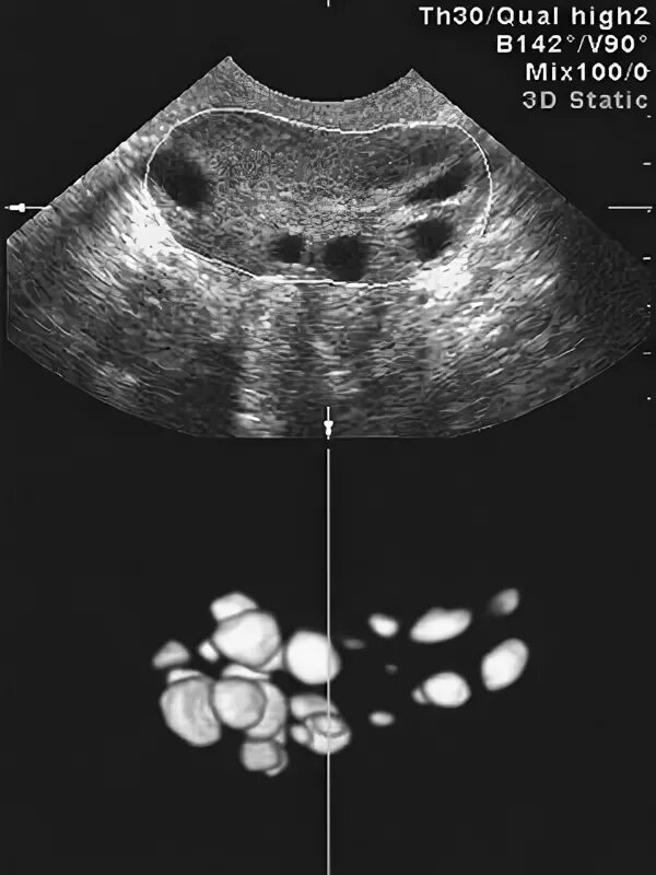УЗИ мультифолликулярных яичников. Поликистоз яичников на УЗИ. Мультифолликулярные яичники и поликистоз. Мультифолликулярные яичники на УЗИ. Мфя в гинекологии что
