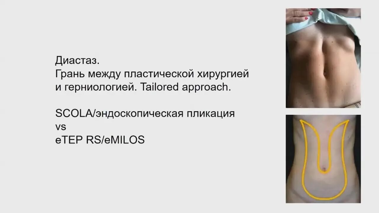 Степень диастаза прямых мышц. Диастаз брюшной полости. диастаз живота и пупочная грыжа. диастаз прямых мышц живота классификация. типы диастаза прямых мышц живота.