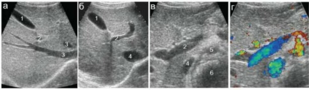 Холедох анатомия УЗИ. Воротная Вена и холедох на УЗИ. Холедох у детей норма УЗИ. Холедох печени норма