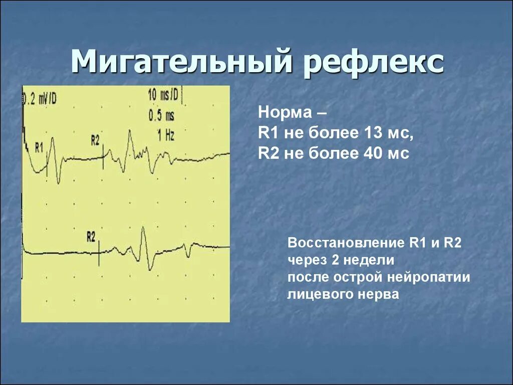 Рефлексы в норме. Мигательный рефлекс электромиография. Исследование мигательного рефлекса ЭМГ. Рефлекс мигательного рефлекса. ЭНМГ презентация.