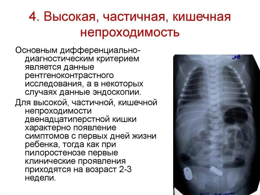 Как лечат непроходимость кишечника у взрослых. Частичная кишечная непроходимость. частичная непроходимость кишечника. высокая кишечная непроходимость симптомы. непроходимость симптомы.