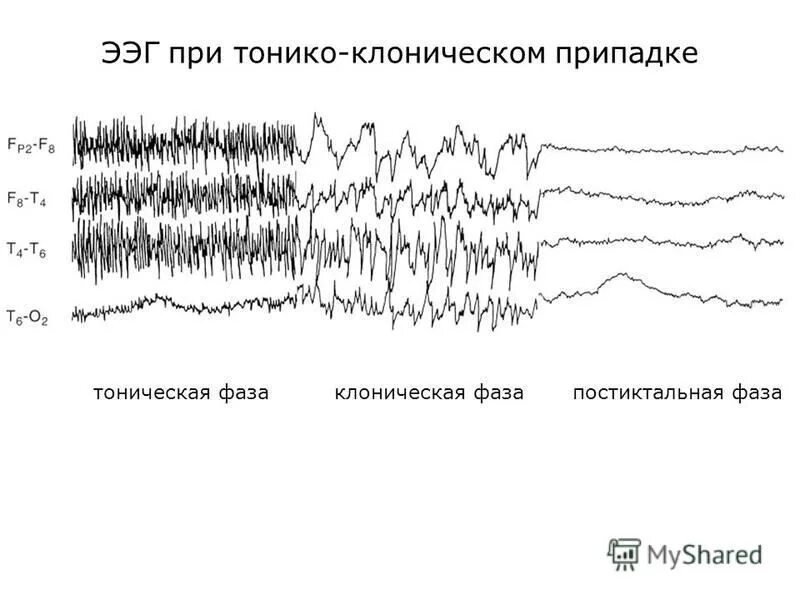 Ээг детям нижний новгород. Патологические ритмы ЭЭГ. ЭЭГ при эпилептическом припадке. ЭЭГ волны при эпилепсии. ЭЭГ головного мозга ритмы.