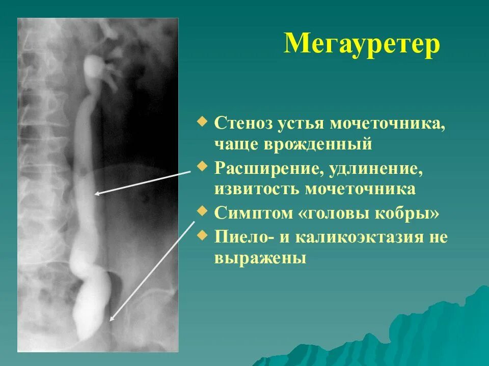 Дилатация мочеточника. Нерефлюксирующий мегауретер. Стеноз Устя мочеточник. Стеноз утся мочеточник. Врожденное расширение мочеточника.