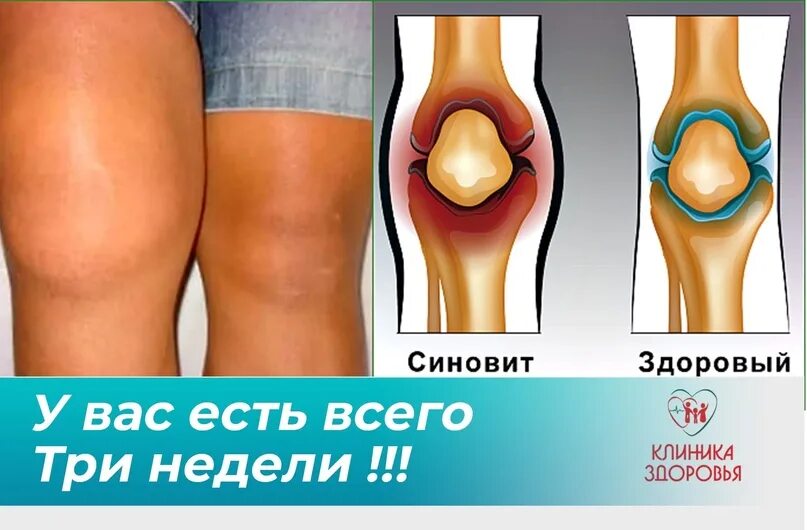 Минимально выраженный синовит. Минимально выраженный синовит