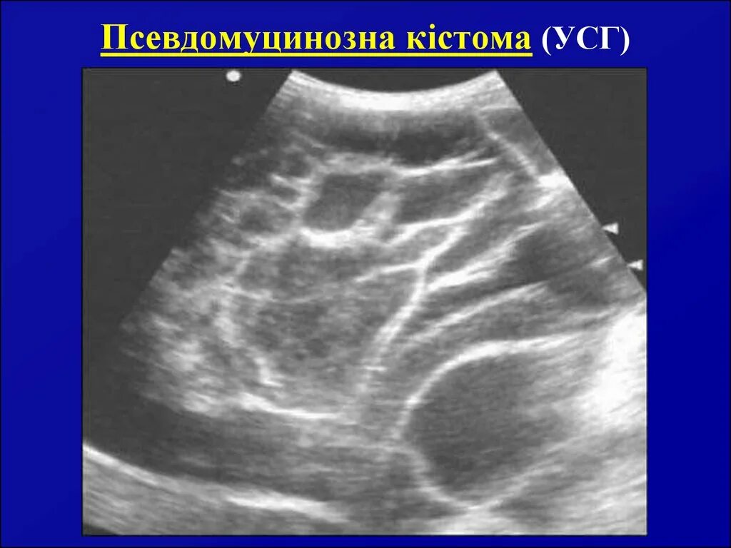 Папиллярная кистома яичника. Муцинозные кисты яичника. Муцинозная цистаденома яичника на УЗИ. Псевдомуцинозная кистома яичника. Муцинозные опухоли яичников