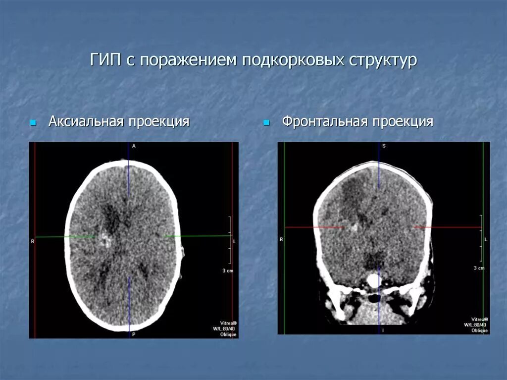 Ишемически гипоксическое поражение головного. Кт головного мозга в аксиальной проекции. Гипоксически-ишемическое поражение головного мозга кт. Проекции компьютерной томографии. Фронтальная проекция кт мозга.