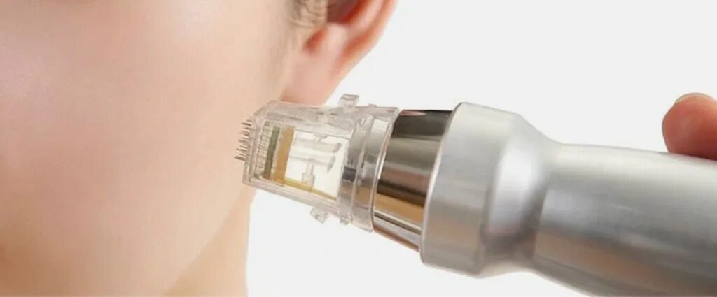 Микроигольчатая процедура. Микроигольчатая процедура. Радиочастотный игольчатый лифтинг. Микроигольчатая процедура. Микроигольчатая процедура.