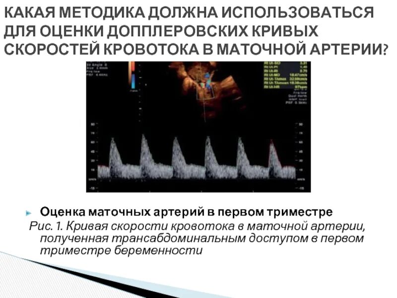 Повышен маточный кровоток. Измерение кровотока в маточных артериях. кривые скоростей кровотока маточных артерий. кровоток в маточных артериях. оценка кровотока.