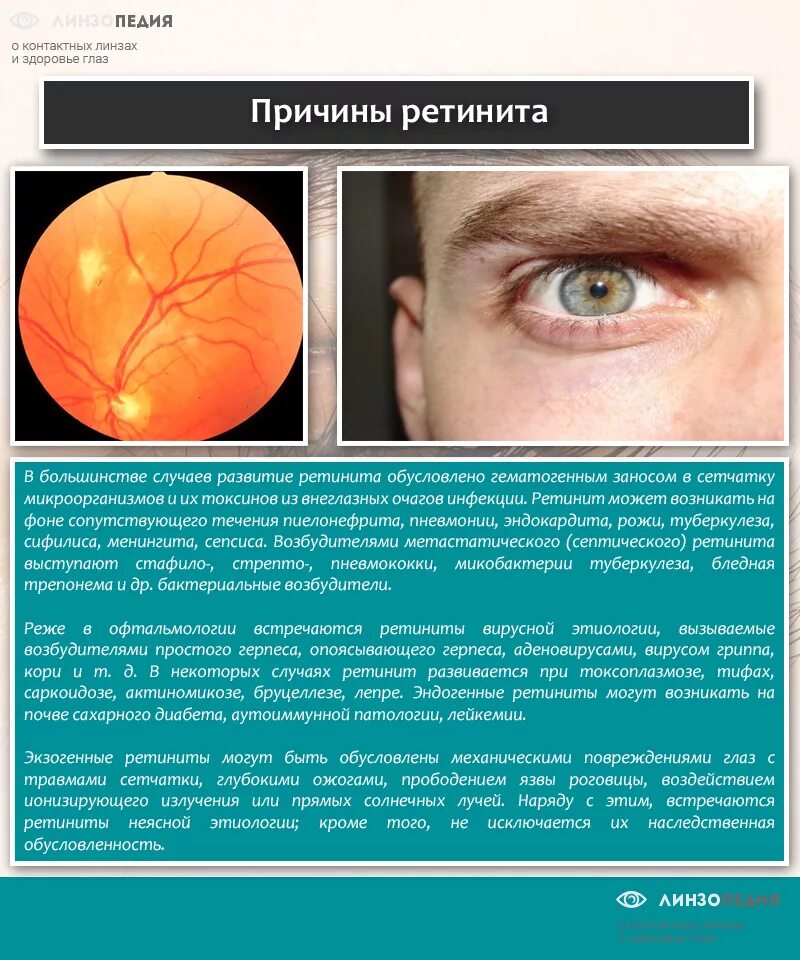 Отслойка сетчатки симптомы. Пигментный ретинит сетчатки. Болезнь с глазами отслоение сетчатки.