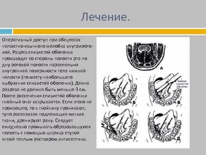 Пространства дна полости рта. Вскрытие абсцесса челюстно-подъязычного желобка. Флегмона челюстно язычного желобка. Абсцессы челюстно-язычной борозды. Абсцесс челбстро язычнрно желоька.